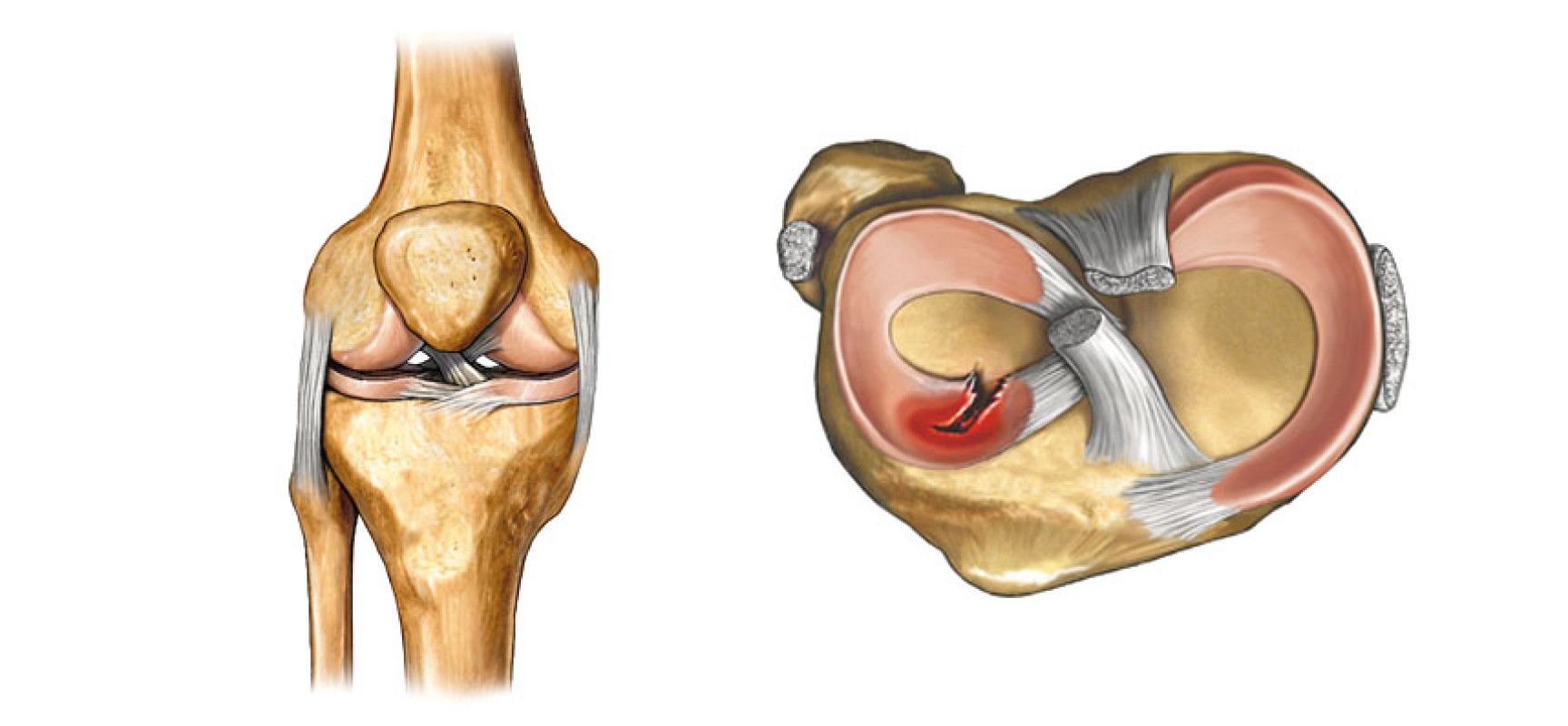Повреждение мениска коленного сустава – виды лечения