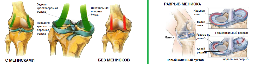 Мр признаки разрыва. Разрыв мениска коленного сустава. Мениск 3 степени коленного. Разрыв мениска коленного сустава рентген. Симптомы повреждения менисков коленного сустава.