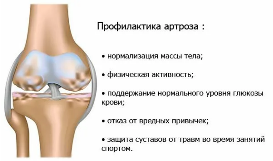 Деформирующий артроз коленного сустава стадии. Артроз коленного сустава памятка. Профилактика артрита коленного сустава. Памятка остеоартроз коленного сустава. Можно греть артроз коленного